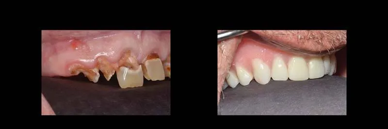 Before and After Full-Mouth Rehabilitation photo 10