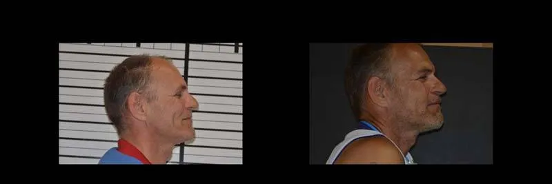 Before and After Full-Mouth Rehabilitation photo 16