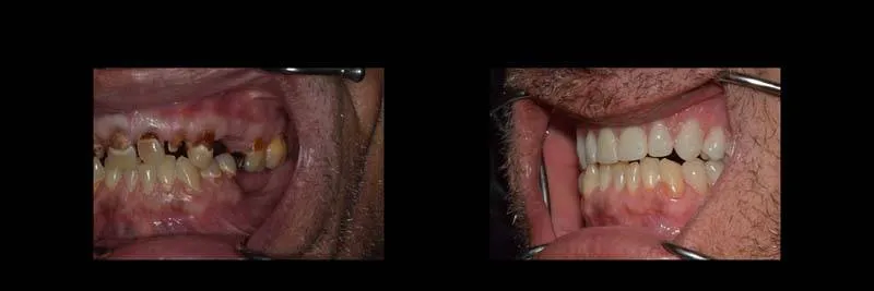 Before and After Full-Mouth Rehabilitation photo 8