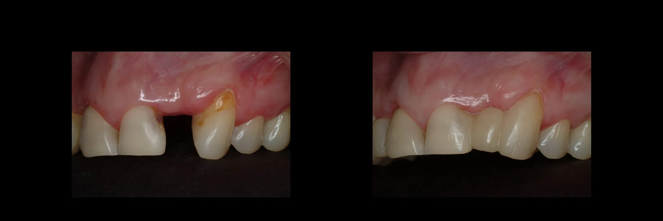 Before and After Provisional/Temporary Bridges photo 10