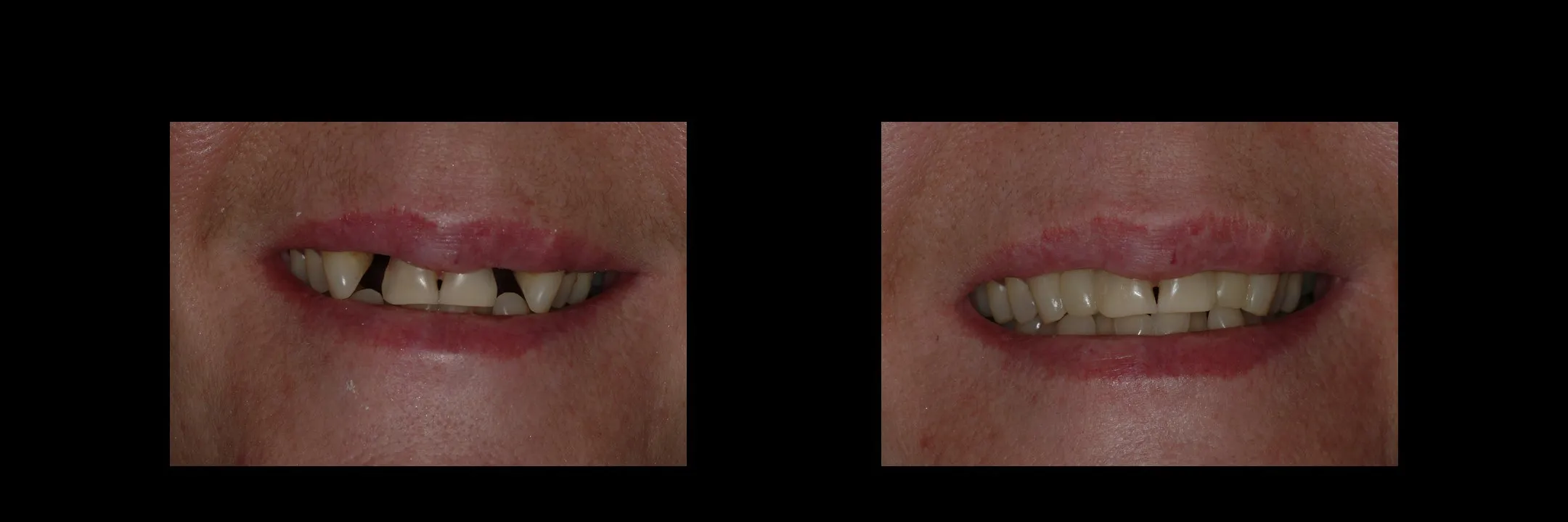 Before and After Provisional/Temporary Bridges photo 2
