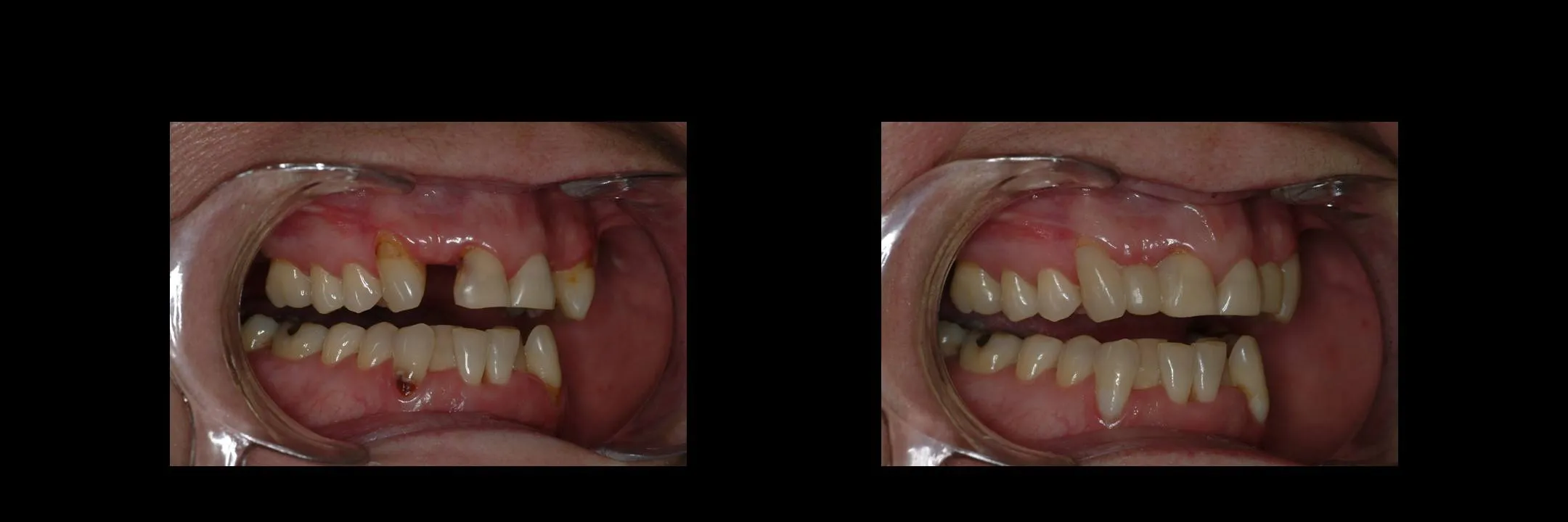 Before and After Provisional/Temporary Bridges photo 6