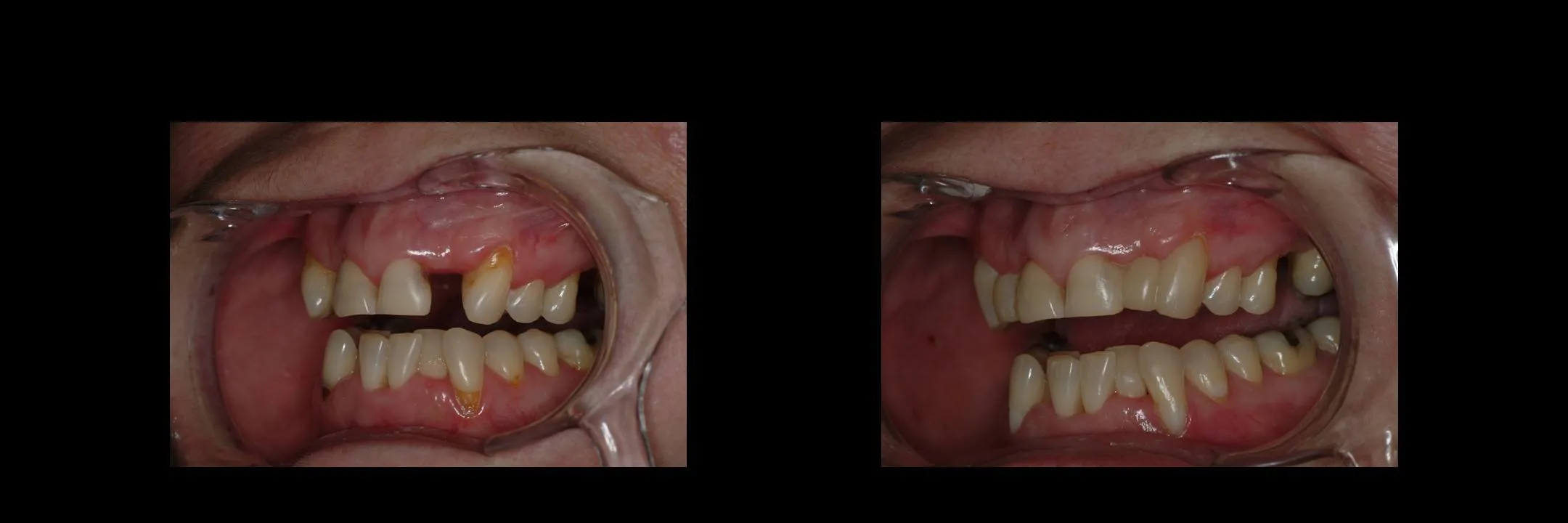 Before and After Provisional/Temporary Bridges photo 7