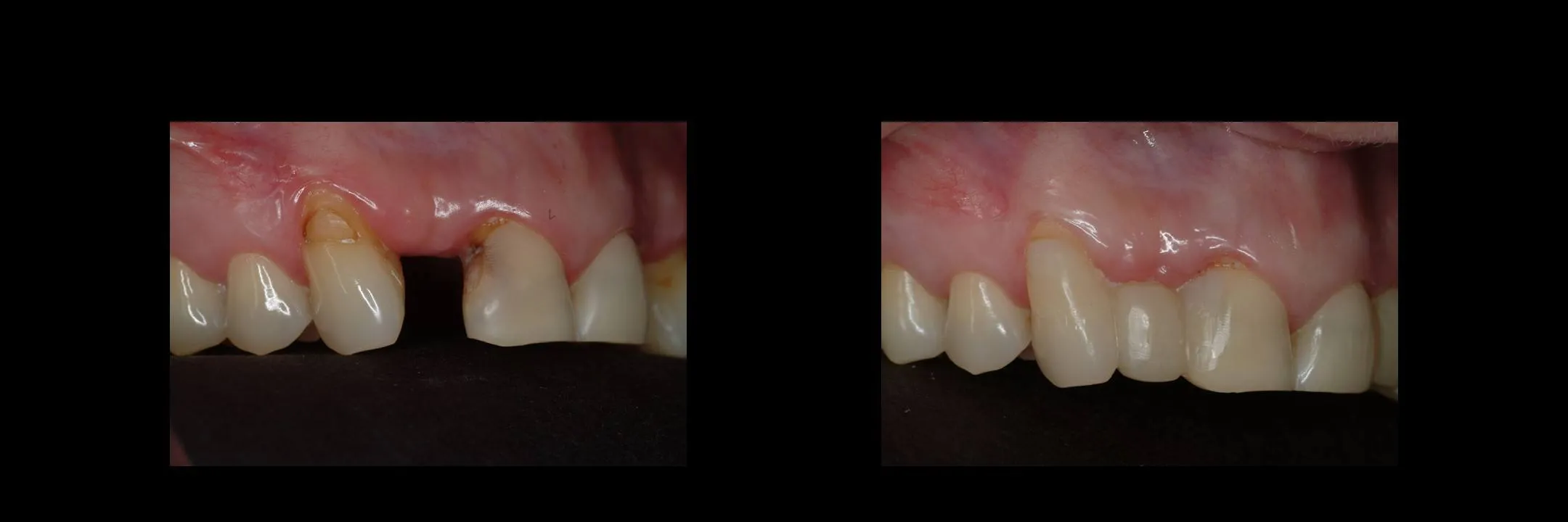 Before and After Provisional/Temporary Bridges photo 9