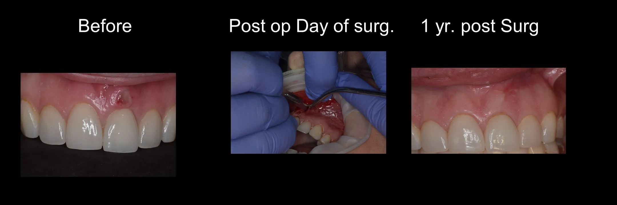 Before and After Excisional Biopsy photo 6