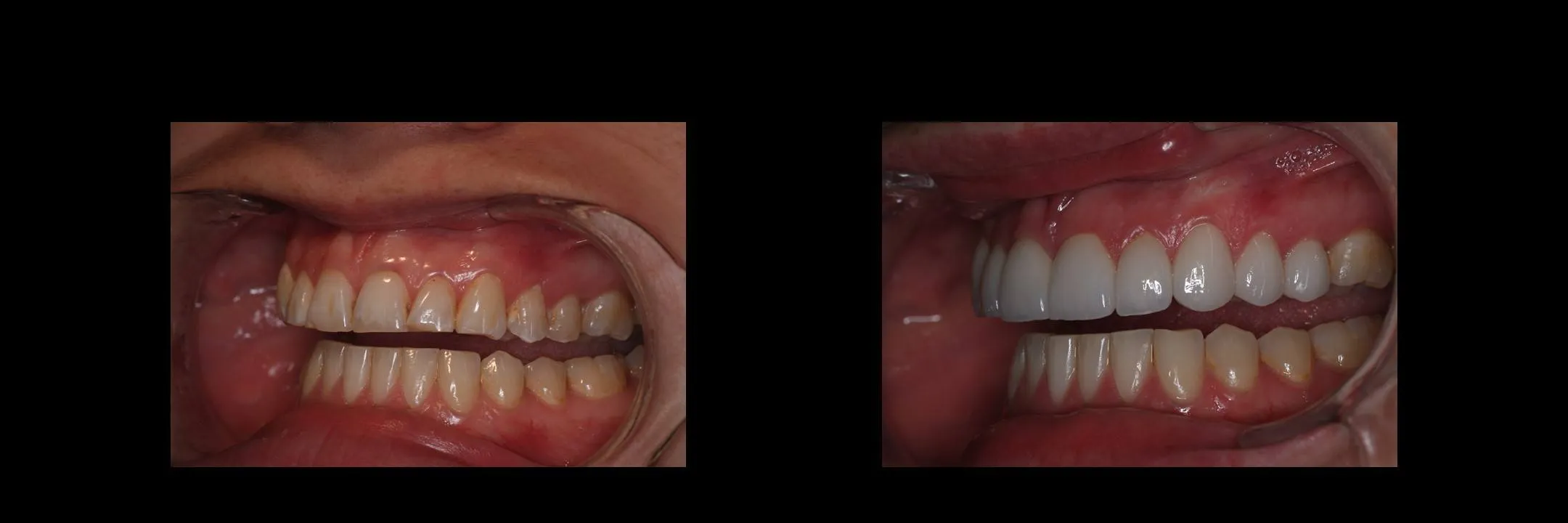 Before and After Porcelain Veneers photo 11