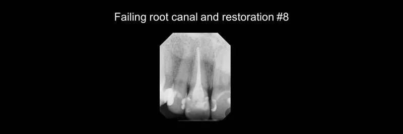 Before and After Single-Implant Restoration photo 2