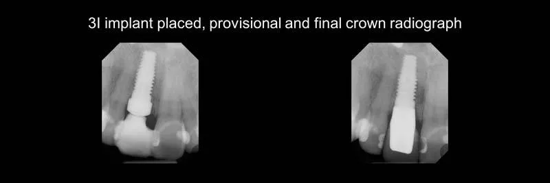 Before and After Single-Implant Restoration photo 3