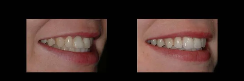 Before and After Single-Implant Restoration photo 8