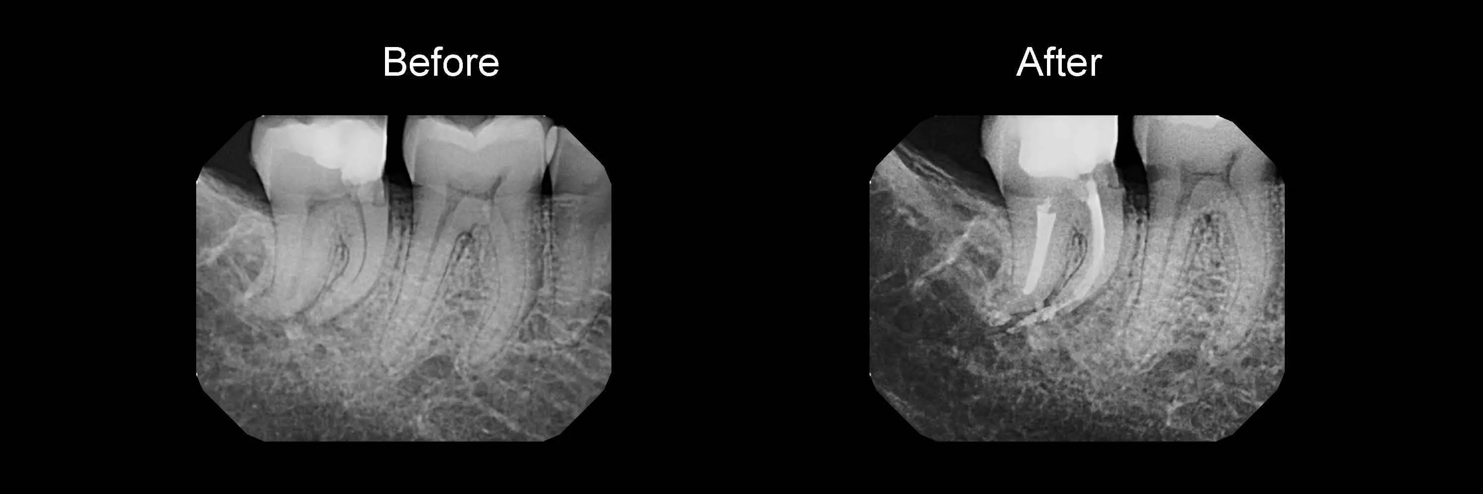 Before and After Safe Root Canals Using Sonendo photo 11