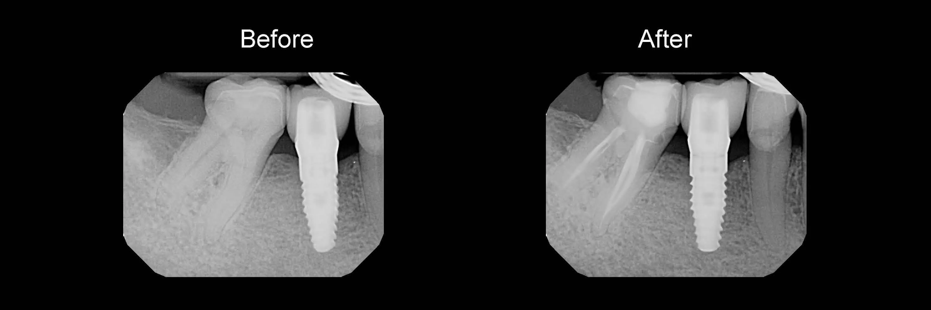Before and After Safe Root Canals Using Sonendo photo 13