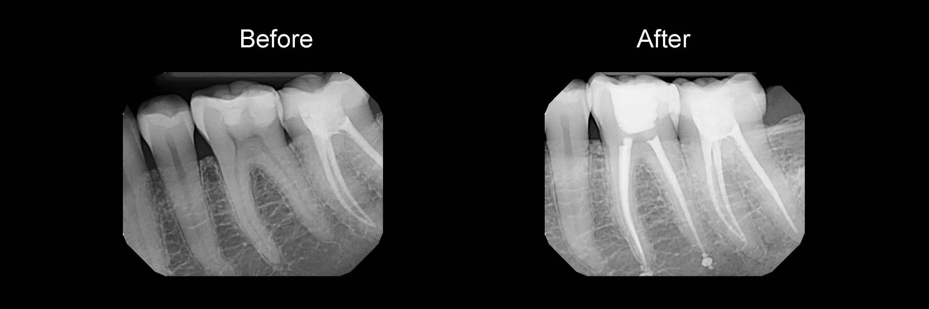 Before and After Safe Root Canals Using Sonendo photo 15