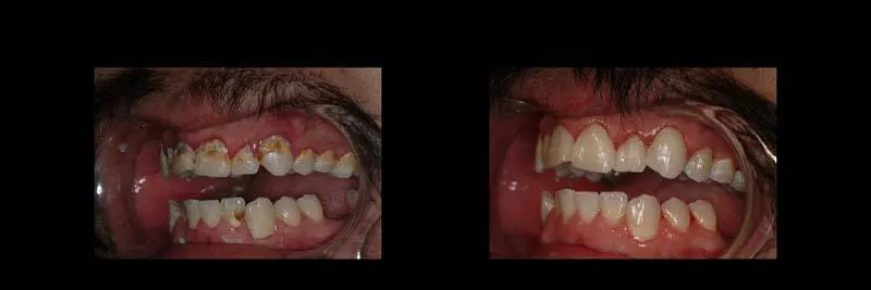 Before and After Composite Restoration & Hygiene Coaching photo 7