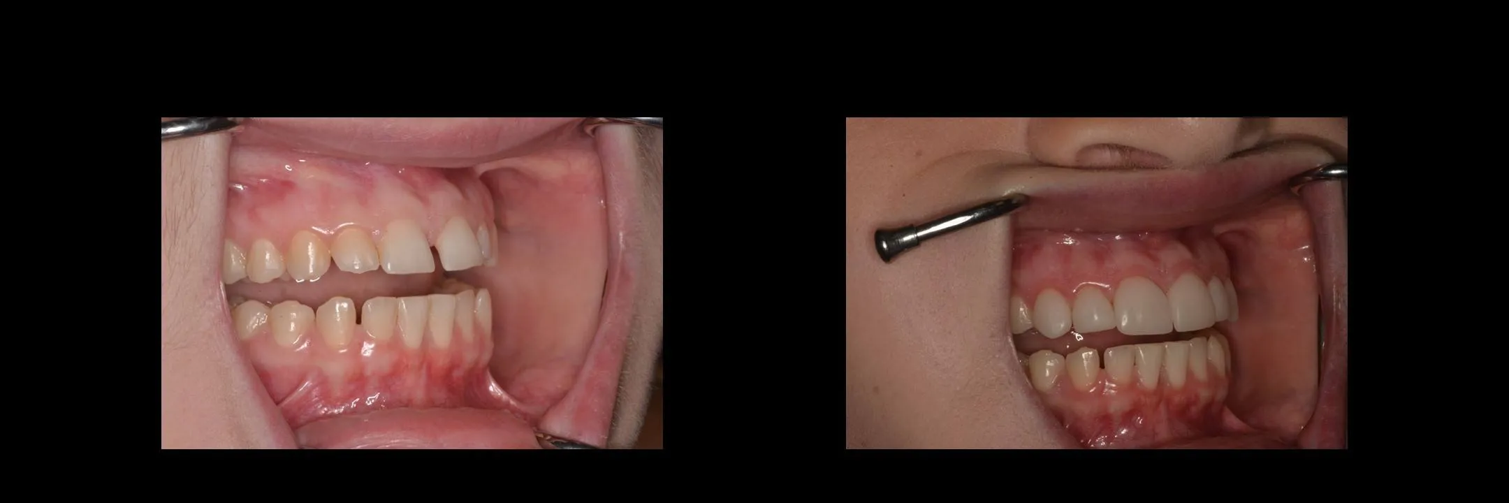 Before and After Minimally Prepared Veneers photo 10