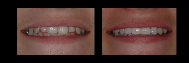 Before and After No Prepartion Veneers photo 2