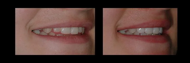 Before and After No Prepartion Veneers photo 3
