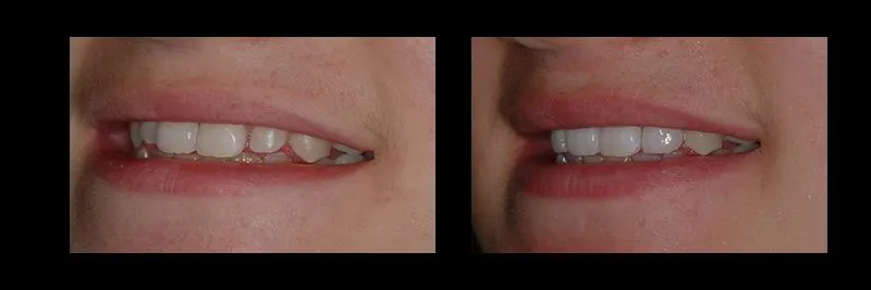 Before and After No Prepartion Veneers photo 4