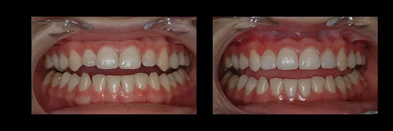 Before and After No Prepartion Veneers photo 5