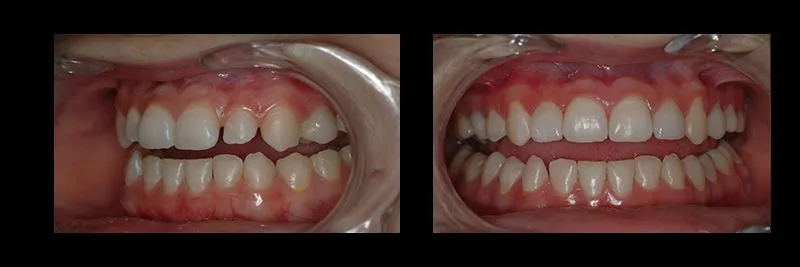 Before and After No Prepartion Veneers photo 7