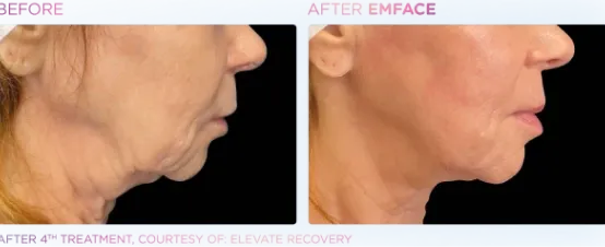 The Dental Studio Aesthetic Tools Before and After Photo 2